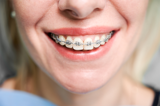 Eine junge Frau lächelt mit ihrer neuen Zahnspange